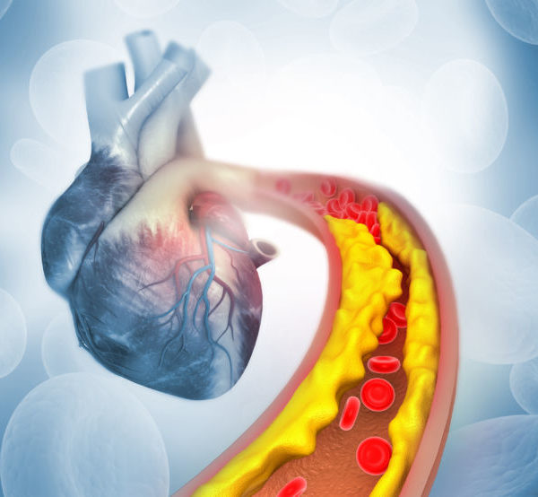 Zvýšený LDL cholesterol ohrožuje i diabetiky. Dá se snížit pomocí vyvážené stravy